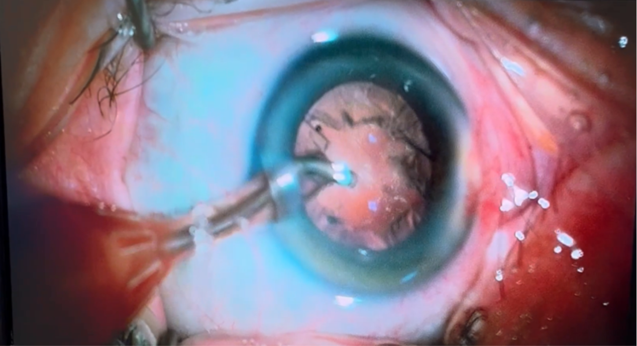 Imagem Cirurgia de Catarata | A Única Forma Eficaz de Tratamento