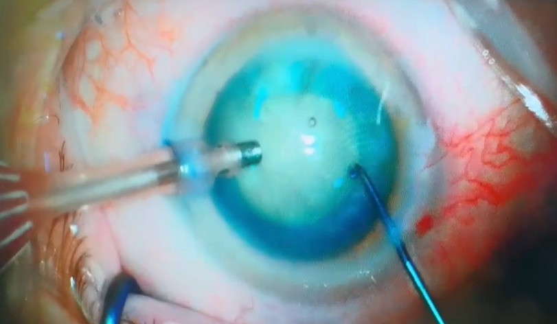 Imagem Cirurgia de Catarata | Sr. Giné
